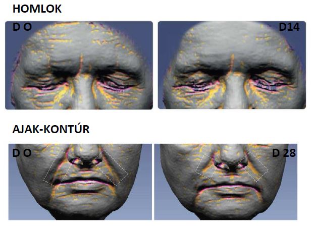 ránctalanító krém, ránctalanító krémek, ránctalanító, ránctalanítás, anti aging krém, szemránckrém, szemkörnyékápoló, legjobb ránctalanító krém, természetes ránctalanító, érett bőr szerkezete