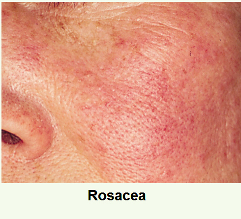 érzékeny bőr, bőrpír, érzékenység, rosacea, cuperosa, lángoló bőr, bőrnyugtatás, érzékeny bőrre